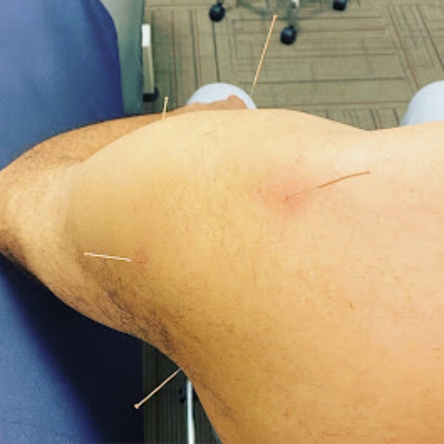 acupuncture-Mt-Lehman-Physiotherapy-Clinic-Abbotsford-BC