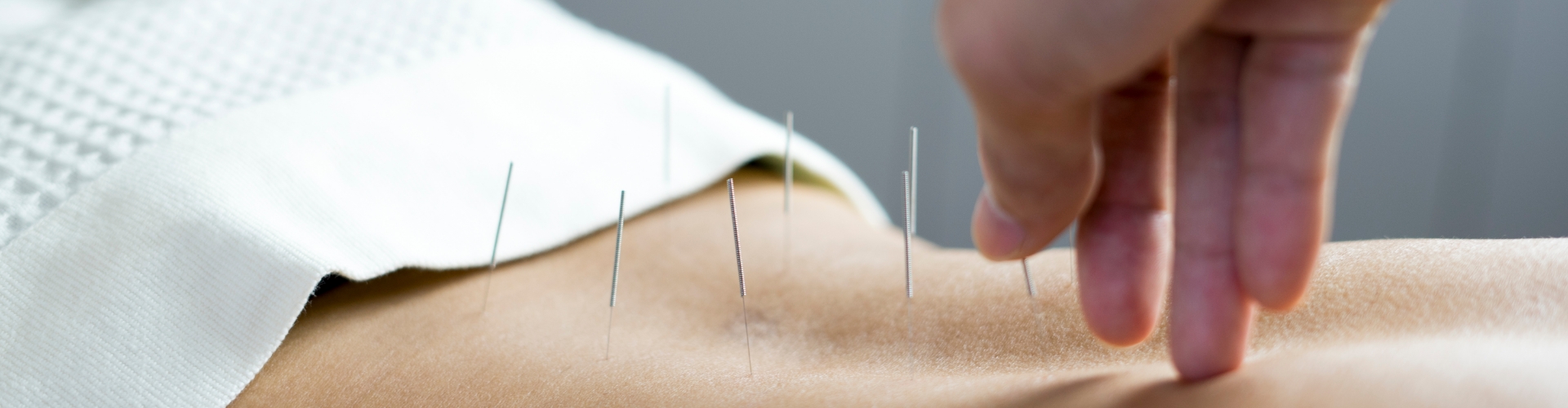 Acupuncture