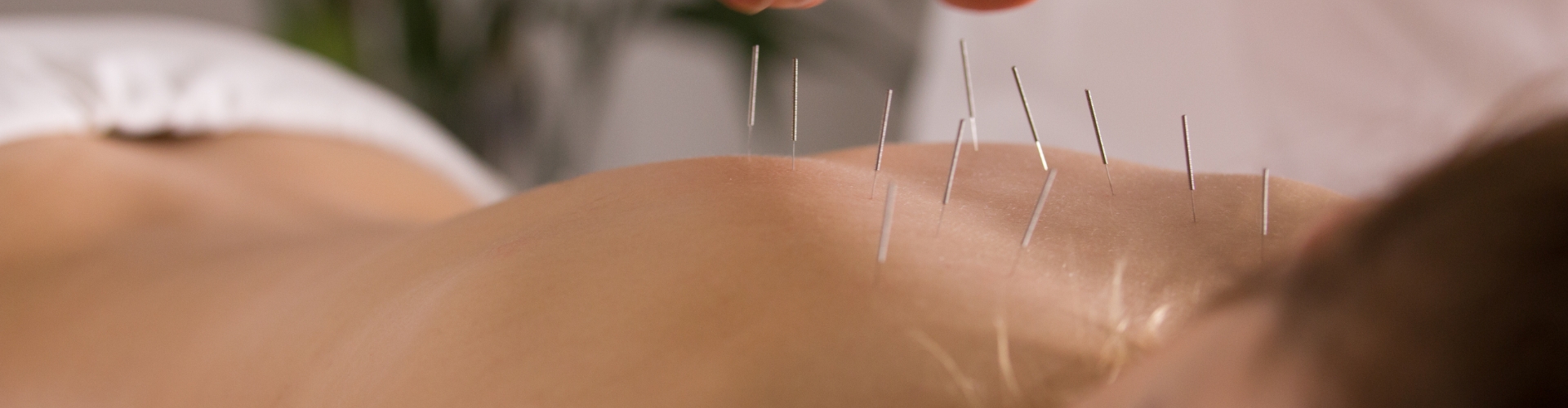 Dry Needling